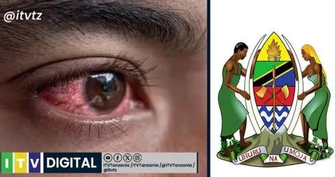 Soma hapa Tahadhari Kuhusu Ugonjwa wa RED EYES Tanzania,Imetolewa leo